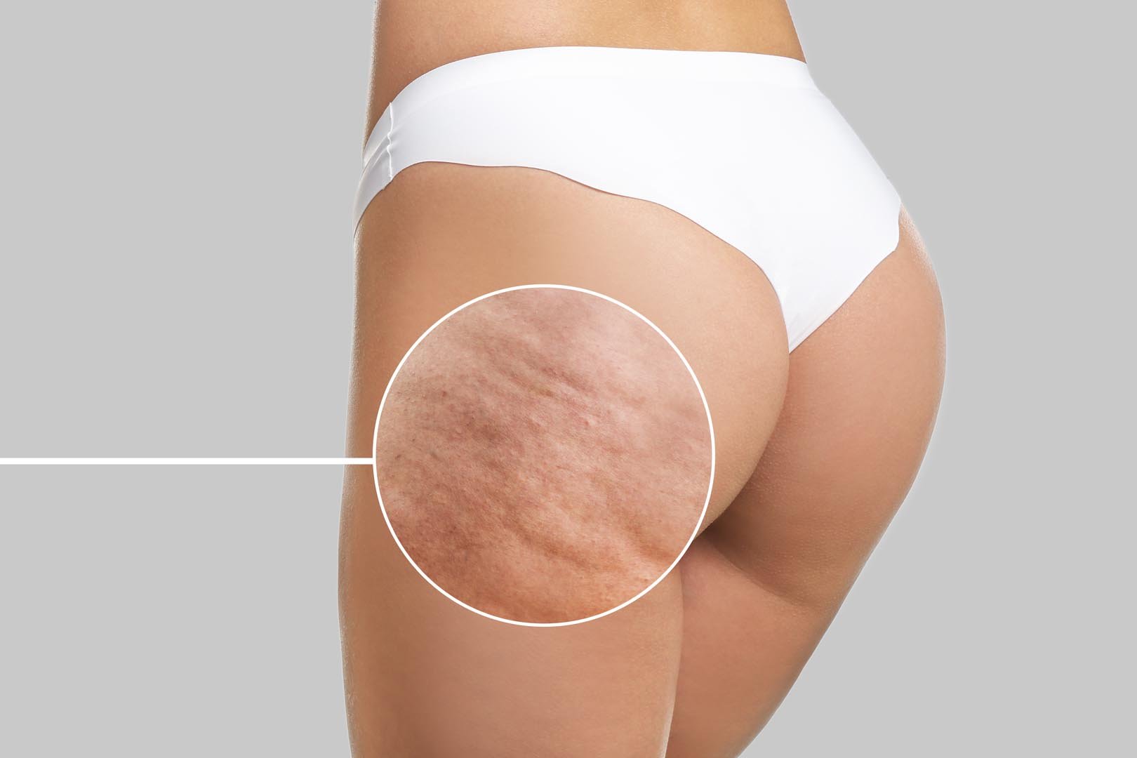 Cellulite Reduction